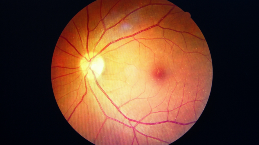 Quality improvement in OCT (optical interference tomography) images.